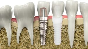 titanio vs zirconio