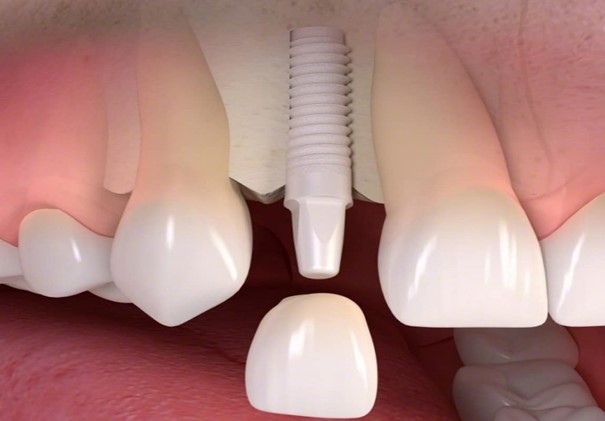 Implante dental de cerámica