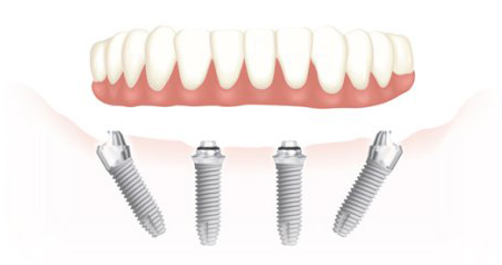 Implantes dentales – Solución „All on 4”